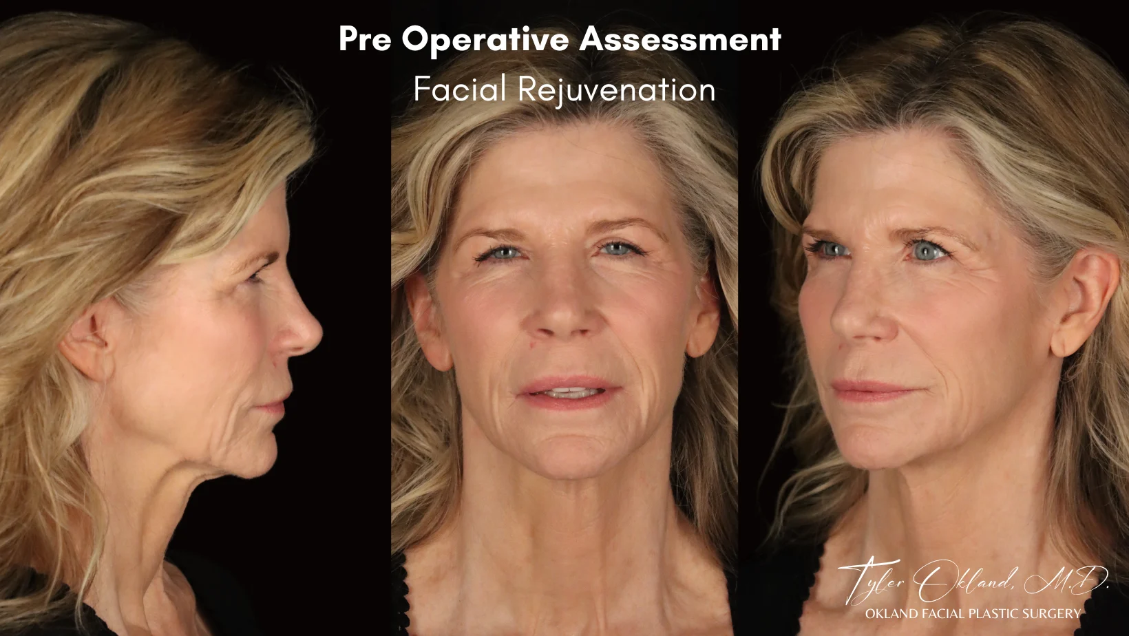 Preoperative facial assessment views for deep plane facelift case study 4.