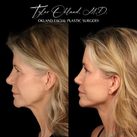 Profile before-and-after comparison after comprehensive facial rejuvenation.