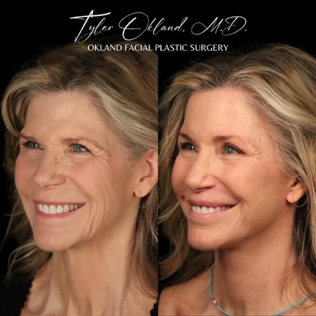 Opposite three-quarter smiling result view after comprehensive facial rejuvenation.