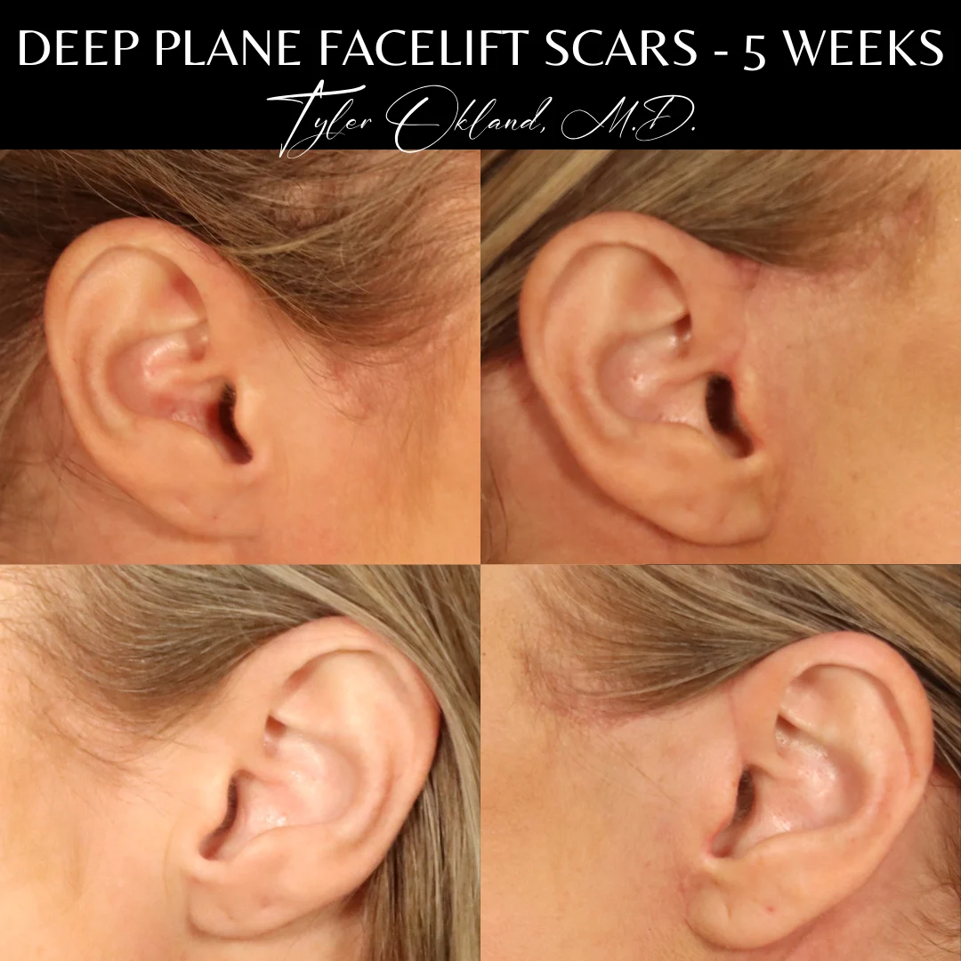 Close-up photographs of deep plane facelift scars five weeks after surgery.