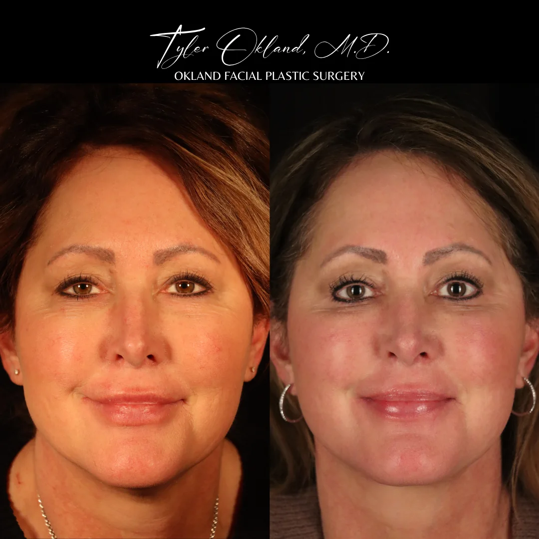 Deep plane facelift before and after results by Dr. Tyler Okland, front view