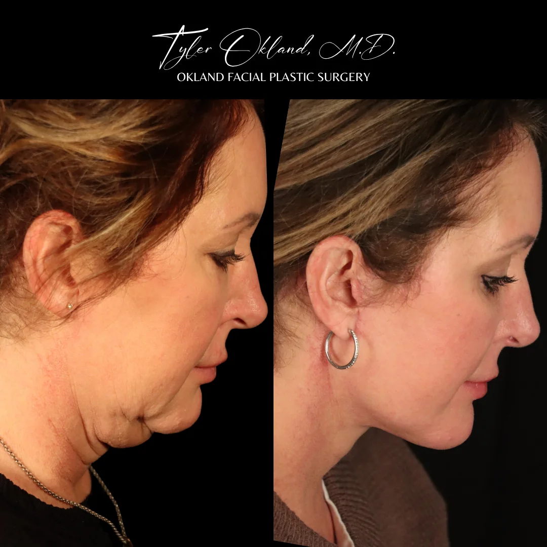 Deep plane facelift before and after results by Dr. Tyler Okland, profile view