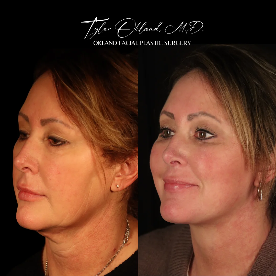 Deep plane facelift before and after results by Dr. Tyler Okland, three-quarter view