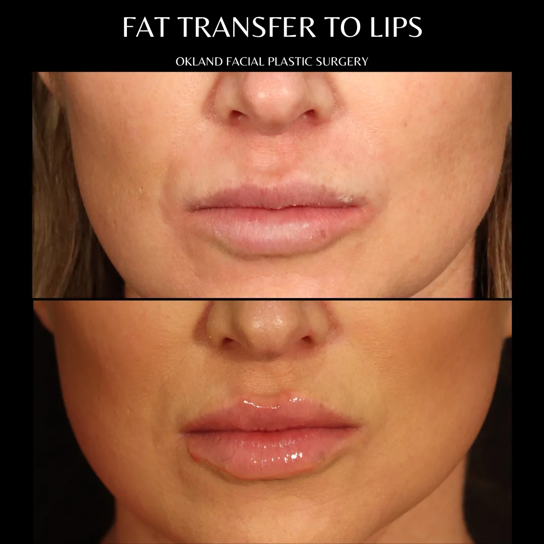 Before-and-after comparison showing restrained fat transfer to the lips.