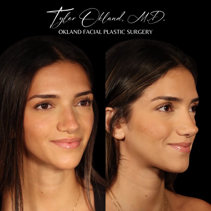 Ethnic rhinoplasty before and after oblique result by Dr. Tyler Okland