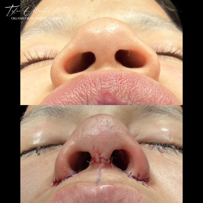 Before-and-after immediate results of alar base reduction (nostril narrowing).