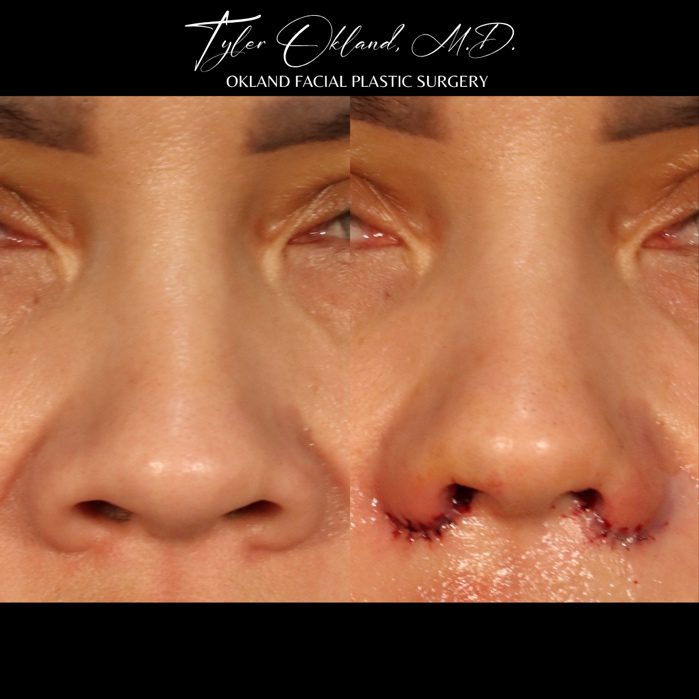 Before-and-after immediate results of alar base reduction (nostril narrowing).