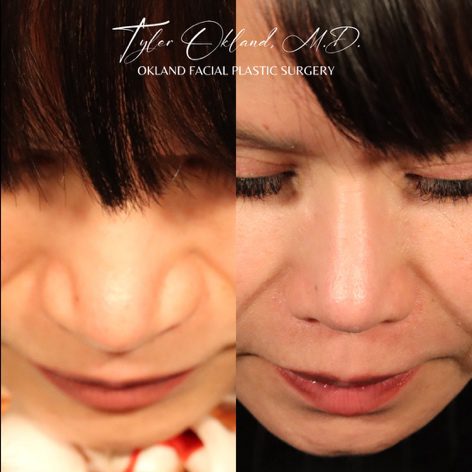 Before-and-after views six months after primary rhinoplasty with rib cartilage dorsal augmentation and nasal narrowing.