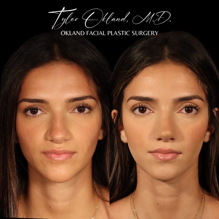 Ethnic rhinoplasty before and after frontal result by Dr. Tyler Okland
