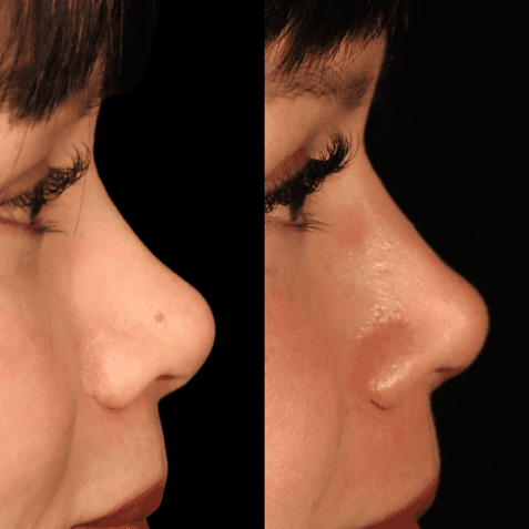 Before-and-after views six months after primary rhinoplasty with rib cartilage dorsal augmentation and nasal narrowing.