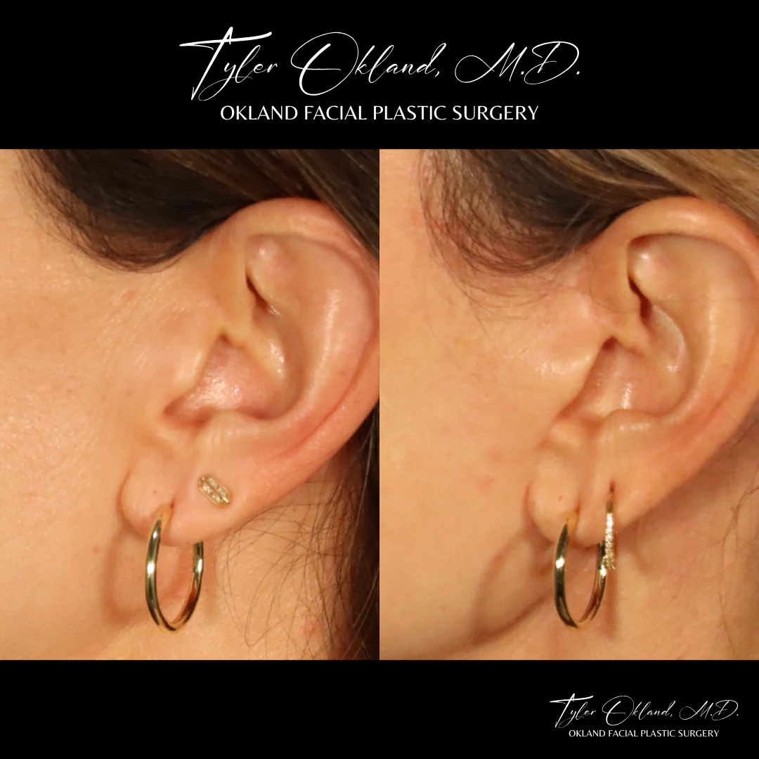 Close-up comparison of a mature facelift scar around the ear.