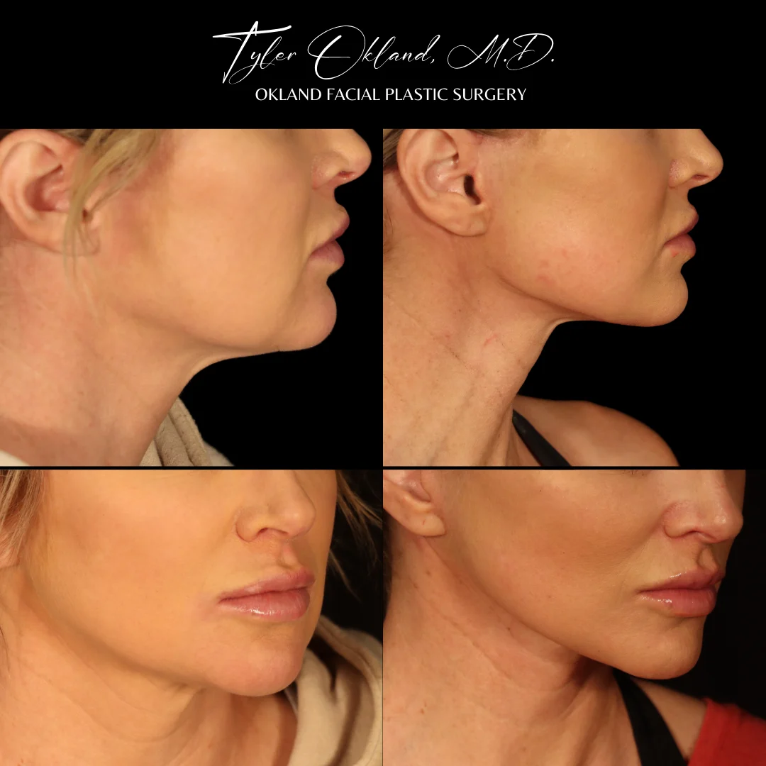 Before-and-after comparison showing changes to the neck and jawline.