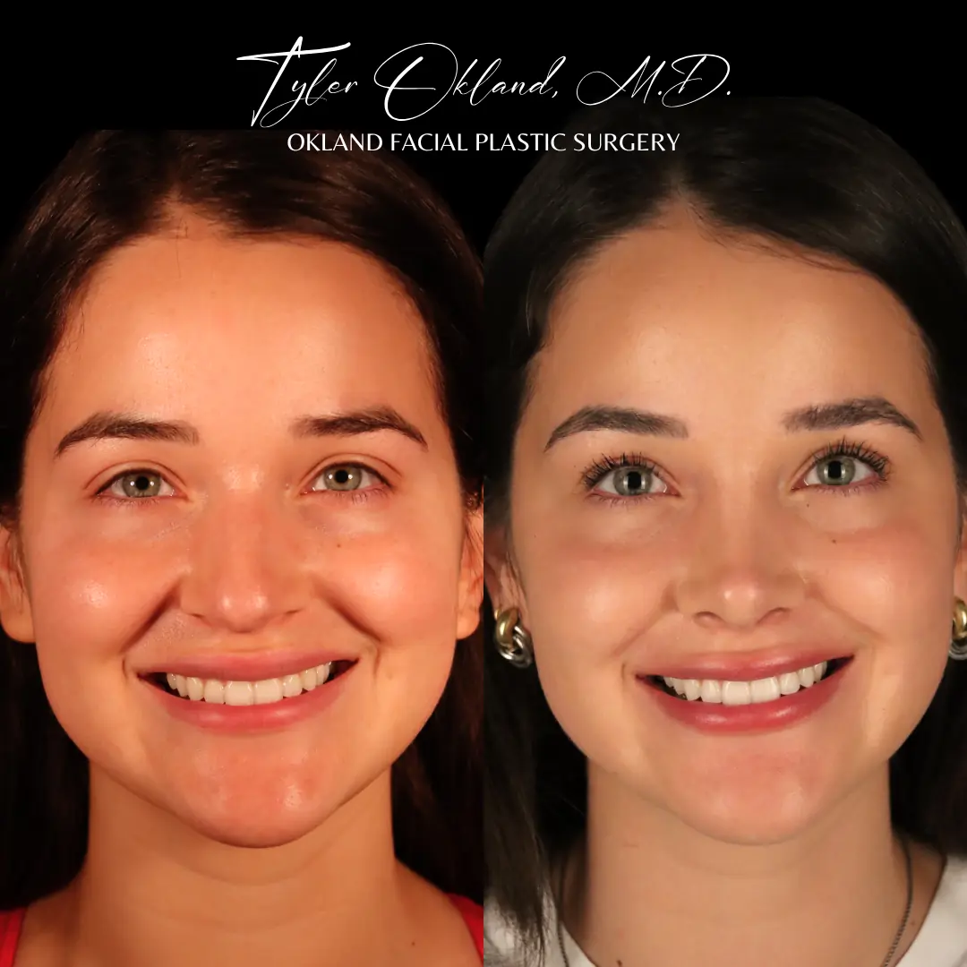 Front view before and after primary rhinoplasty performed by Dr. Tyler Okland in Denver