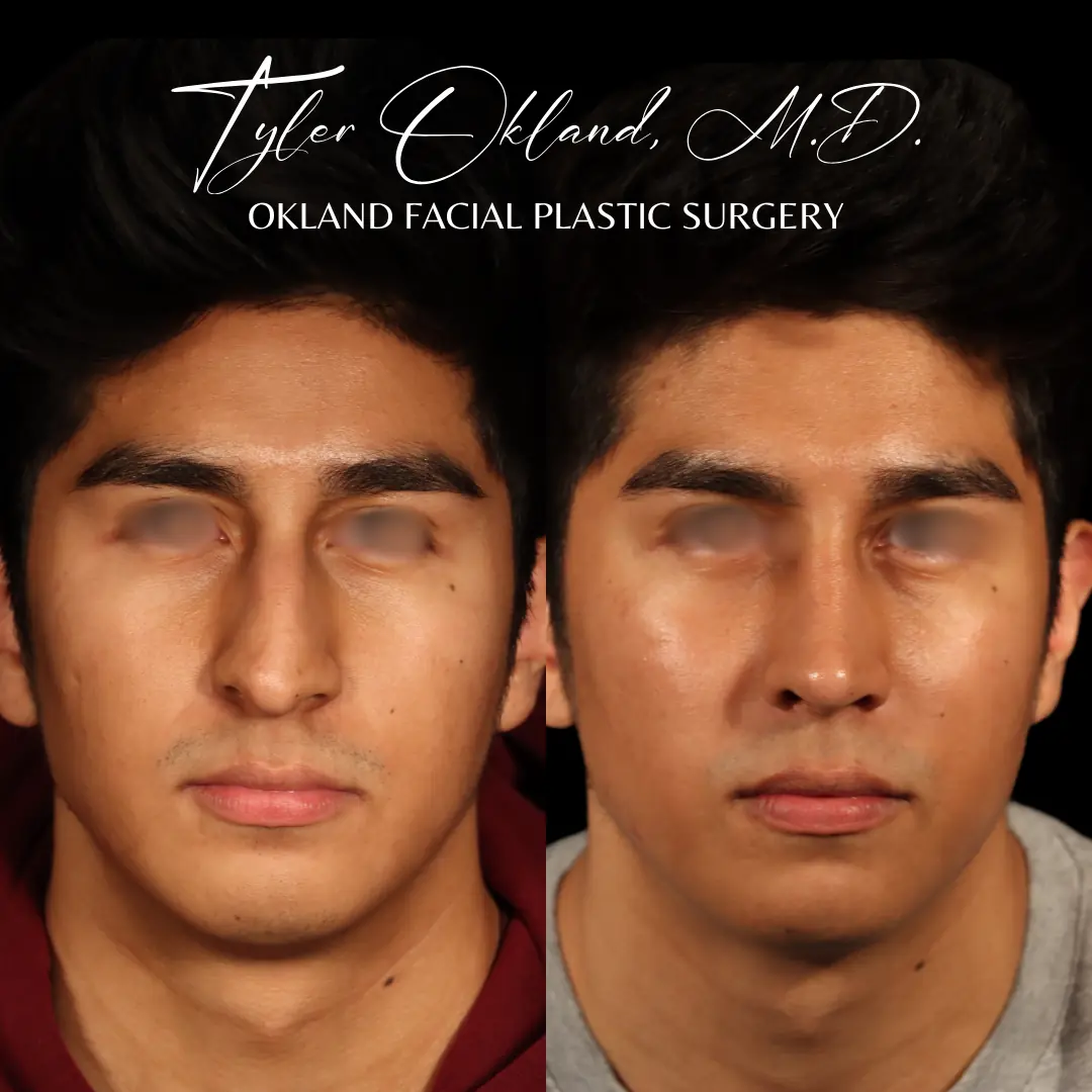 Front view before and after primary rhinoplasty performed by Dr. Tyler Okland in Denver