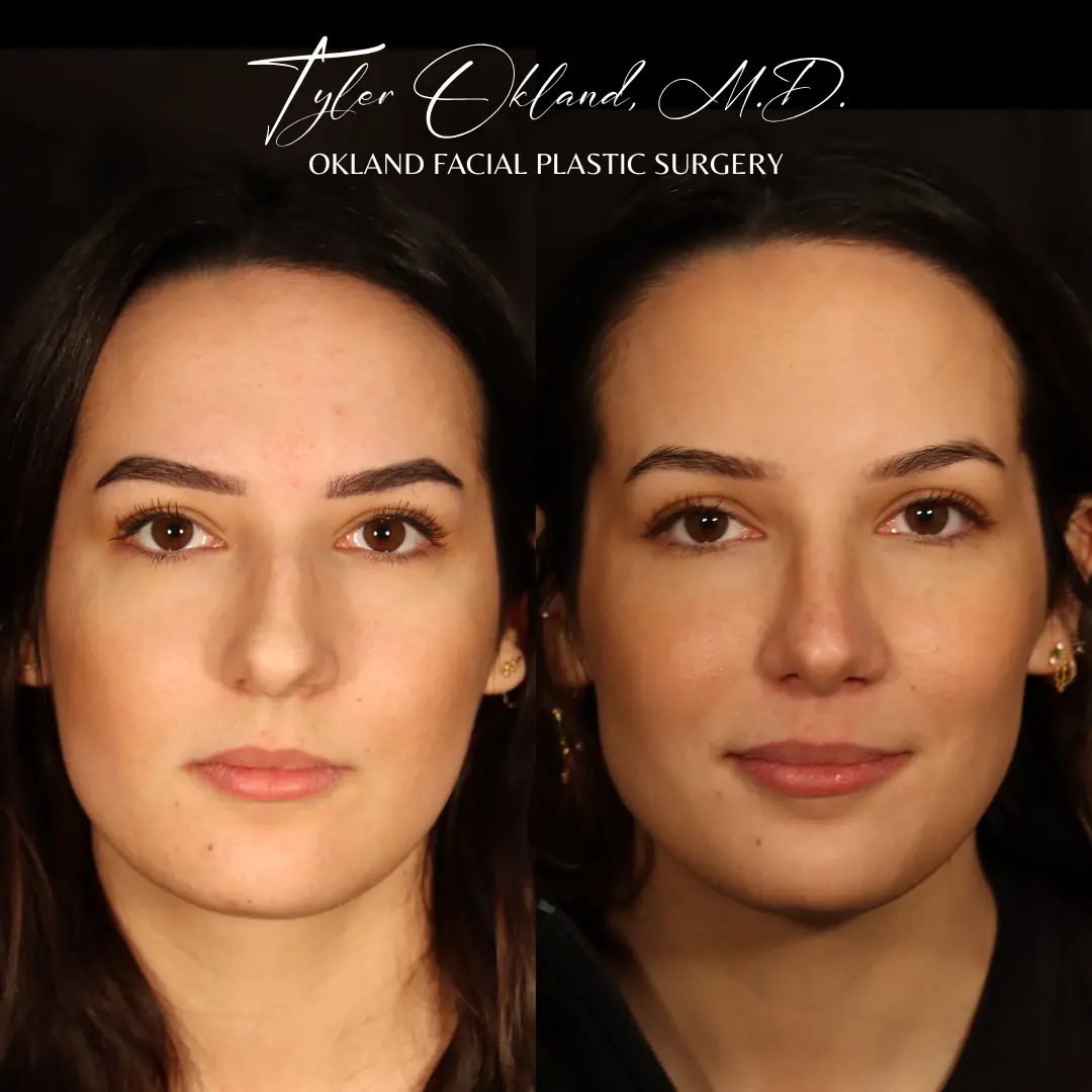 Front view before and after primary rhinoplasty performed by Dr. Tyler Okland in Denver