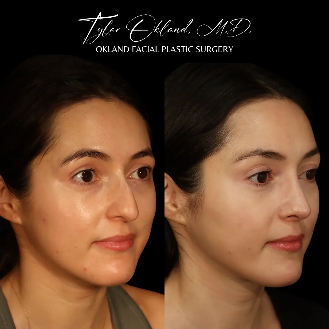 Three-quarter view before and after primary rhinoplasty performed by Dr. Tyler Okland in Denver