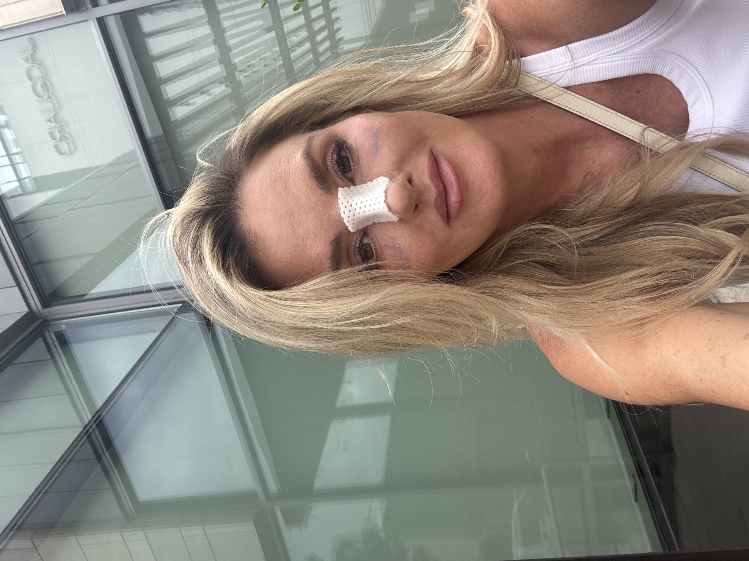 Day 5 after rhinoplasty with the thermoplastic cast still in place.