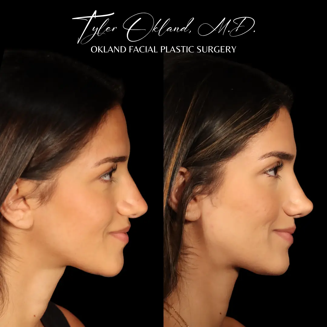 Side profile before and after revision rhinoplasty performed by Dr. Tyler Okland in Denver