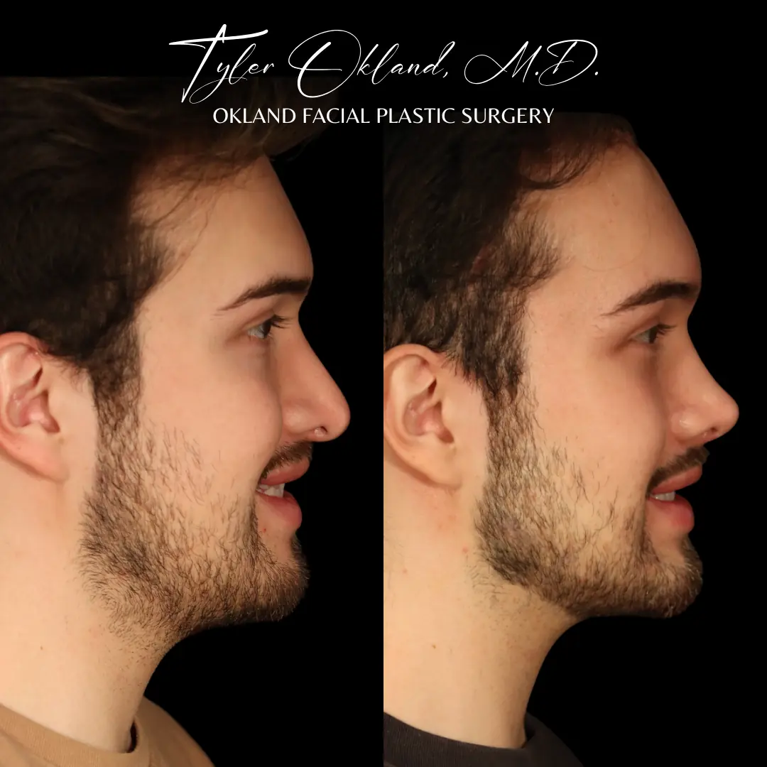 Side profile before and after revision rhinoplasty performed by Dr. Tyler Okland in Denver
