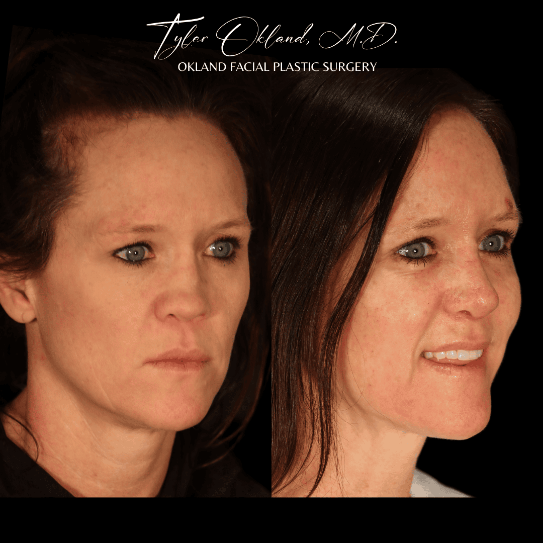 Before and after revision rhinoplasty result by Dr. Tyler Okland in Denver, case 16