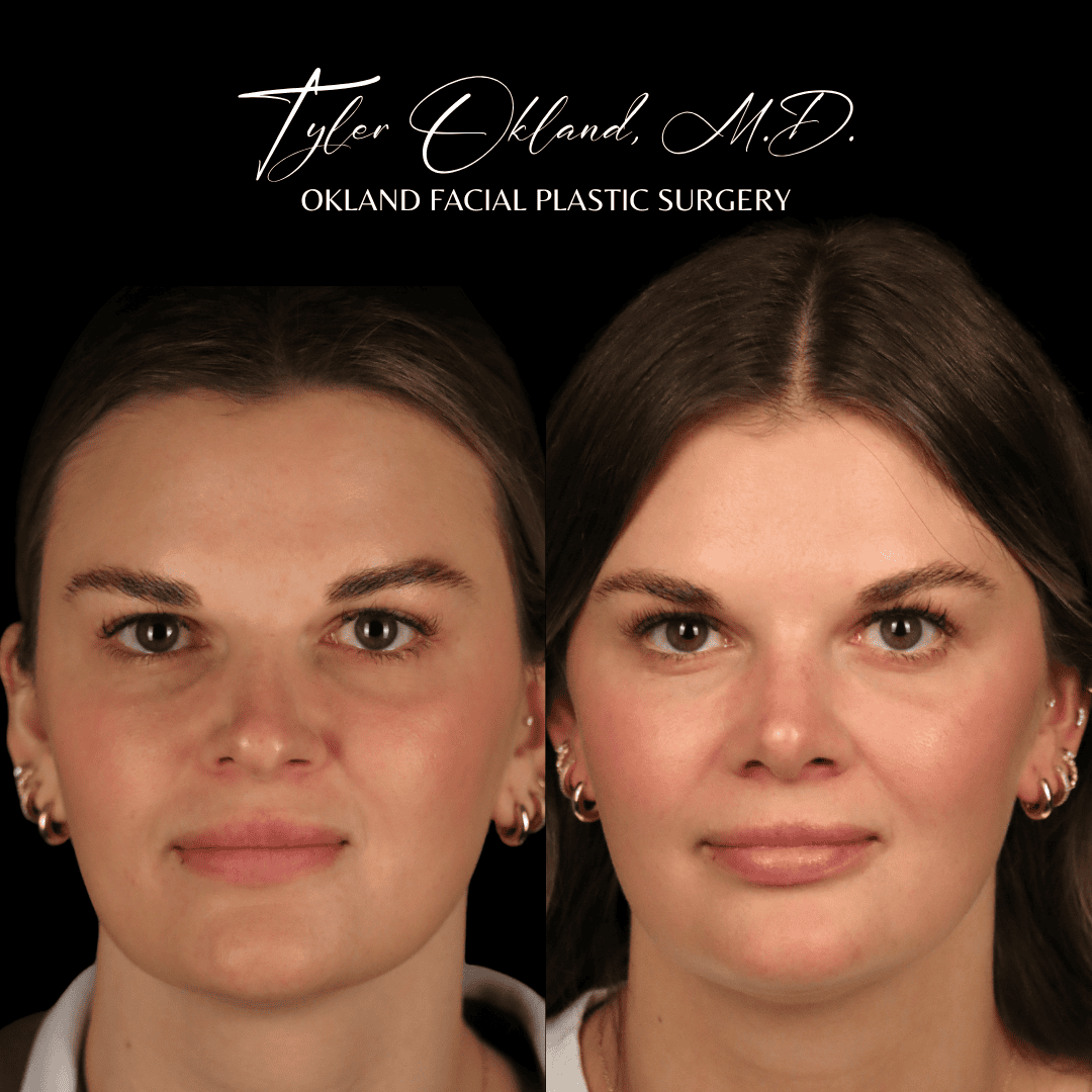 Before and after primary rhinoplasty result by Dr. Tyler Okland in Denver, case 12