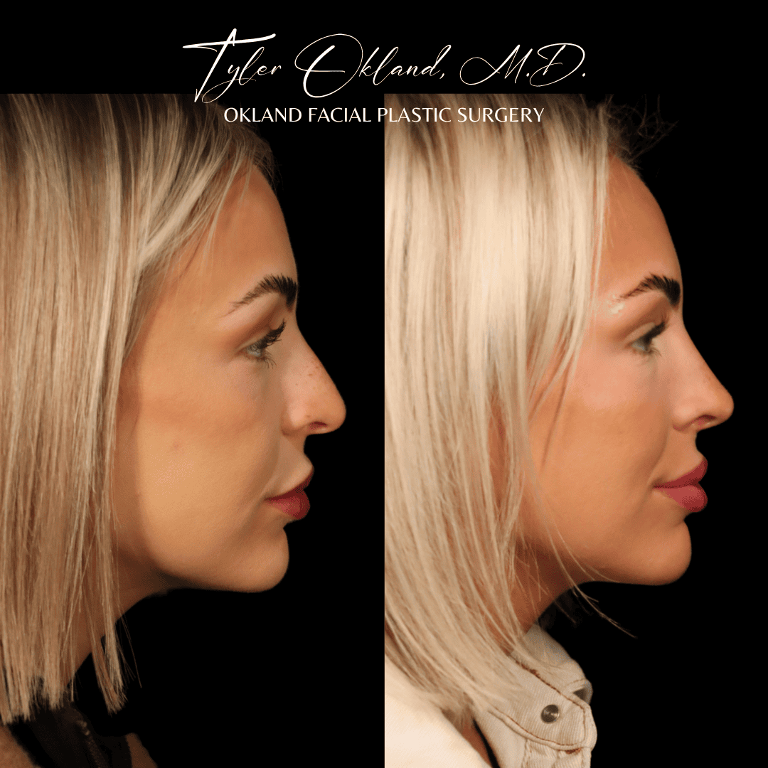 Before and after primary rhinoplasty result by Dr. Tyler Okland in Denver, case 15
