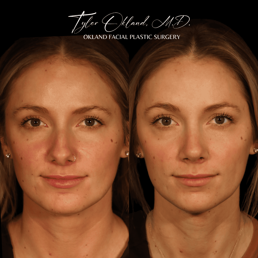 Before and after primary rhinoplasty result by Dr. Tyler Okland in Denver, case 13