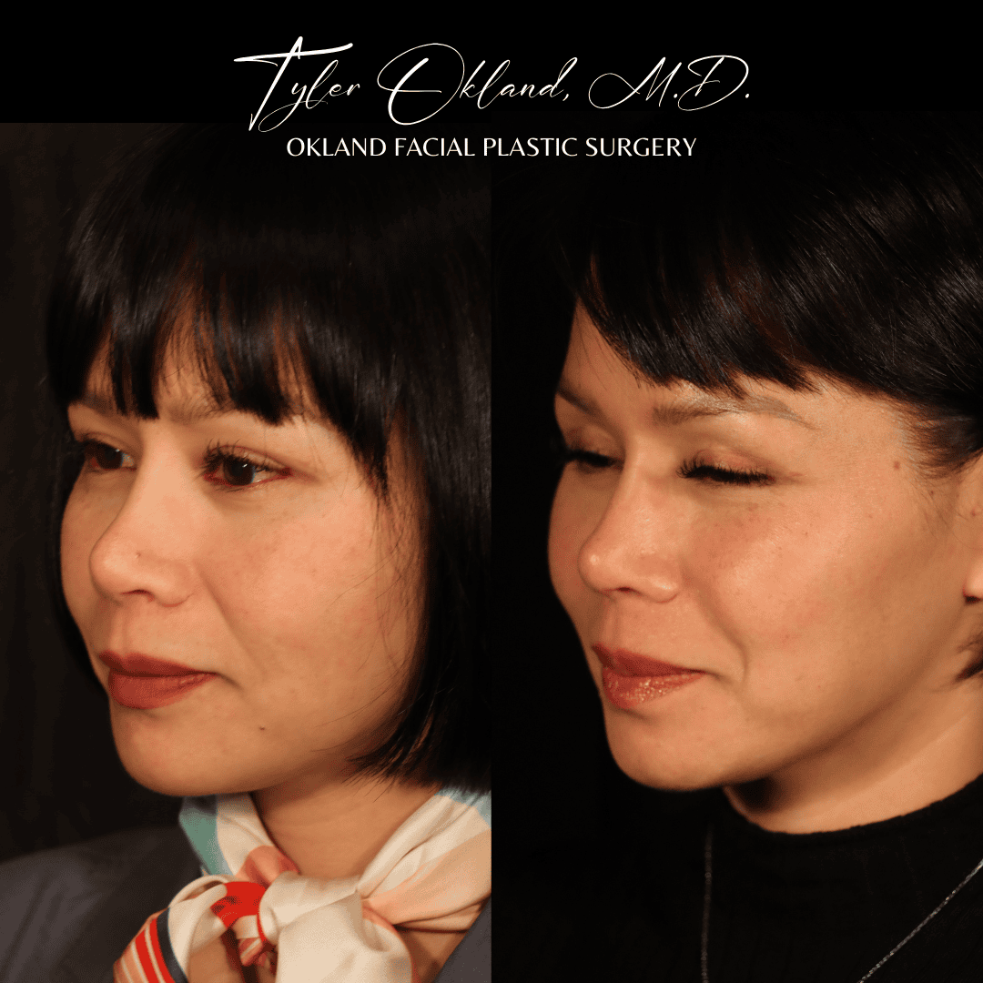 Before and after primary rhinoplasty result by Dr. Tyler Okland in Denver, case 14