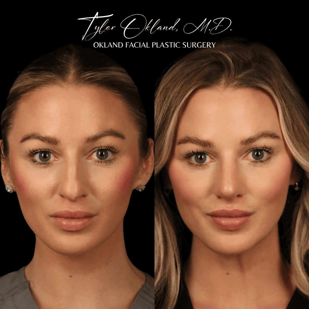 Before and after primary rhinoplasty result by Dr. Tyler Okland in Denver, case 11