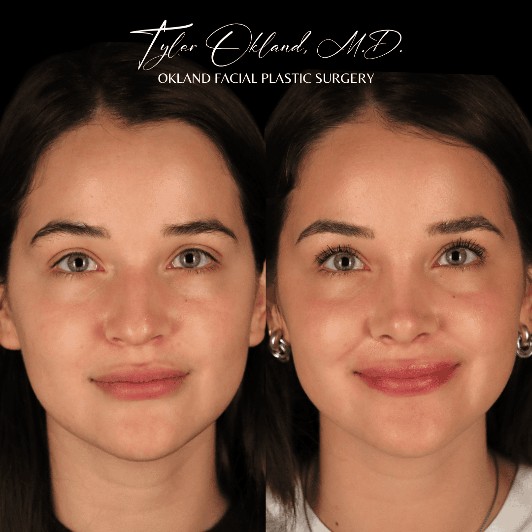 Primary rhinoplasty before and after result by Dr. Tyler Okland