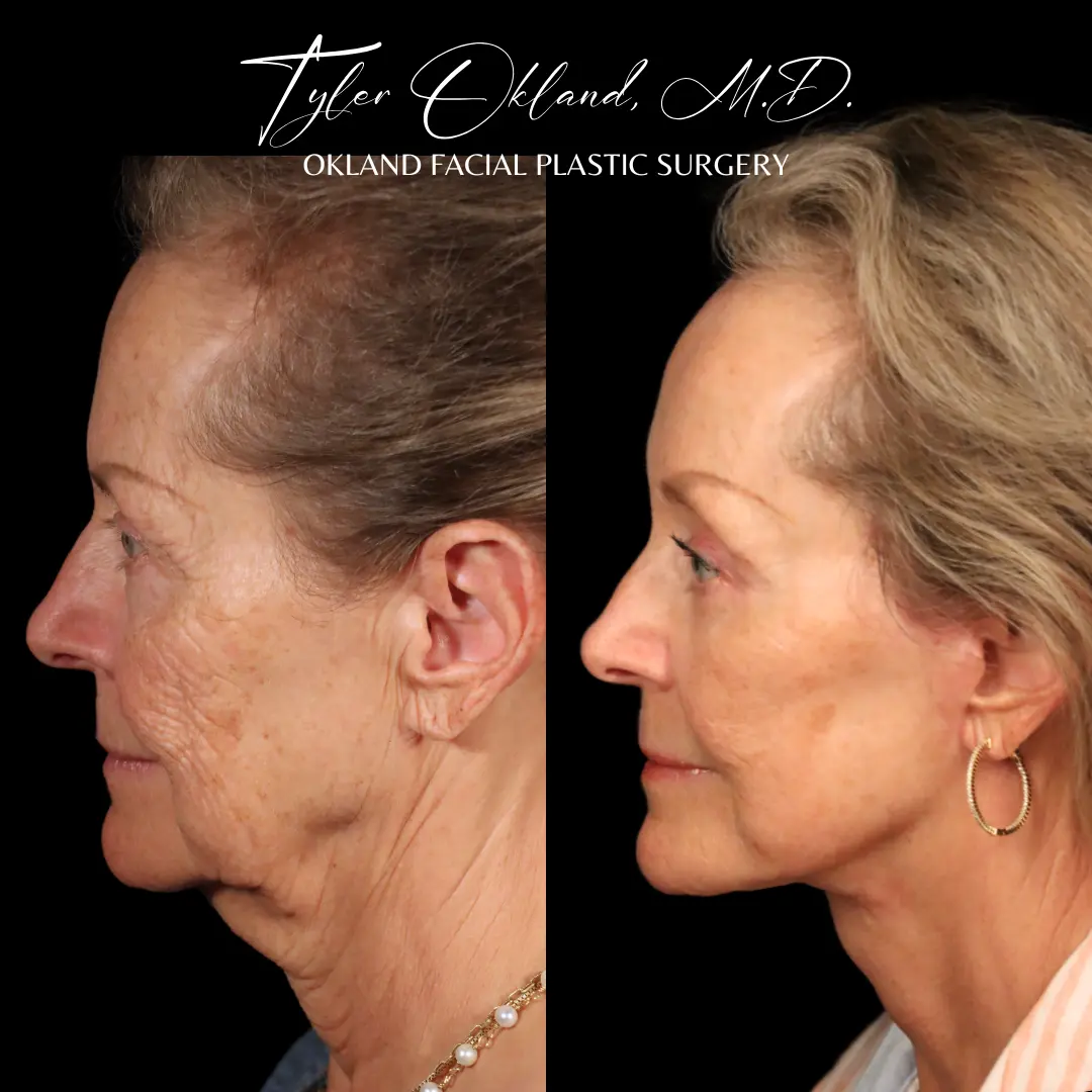 Before and after deep plane facelift and facial rejuvenation by Dr. Tyler Okland in Denver, case 01