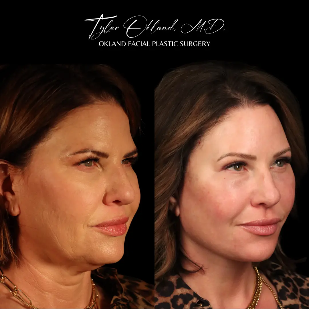 Before and after deep plane facelift and facial rejuvenation by Dr. Tyler Okland in Denver, case 02