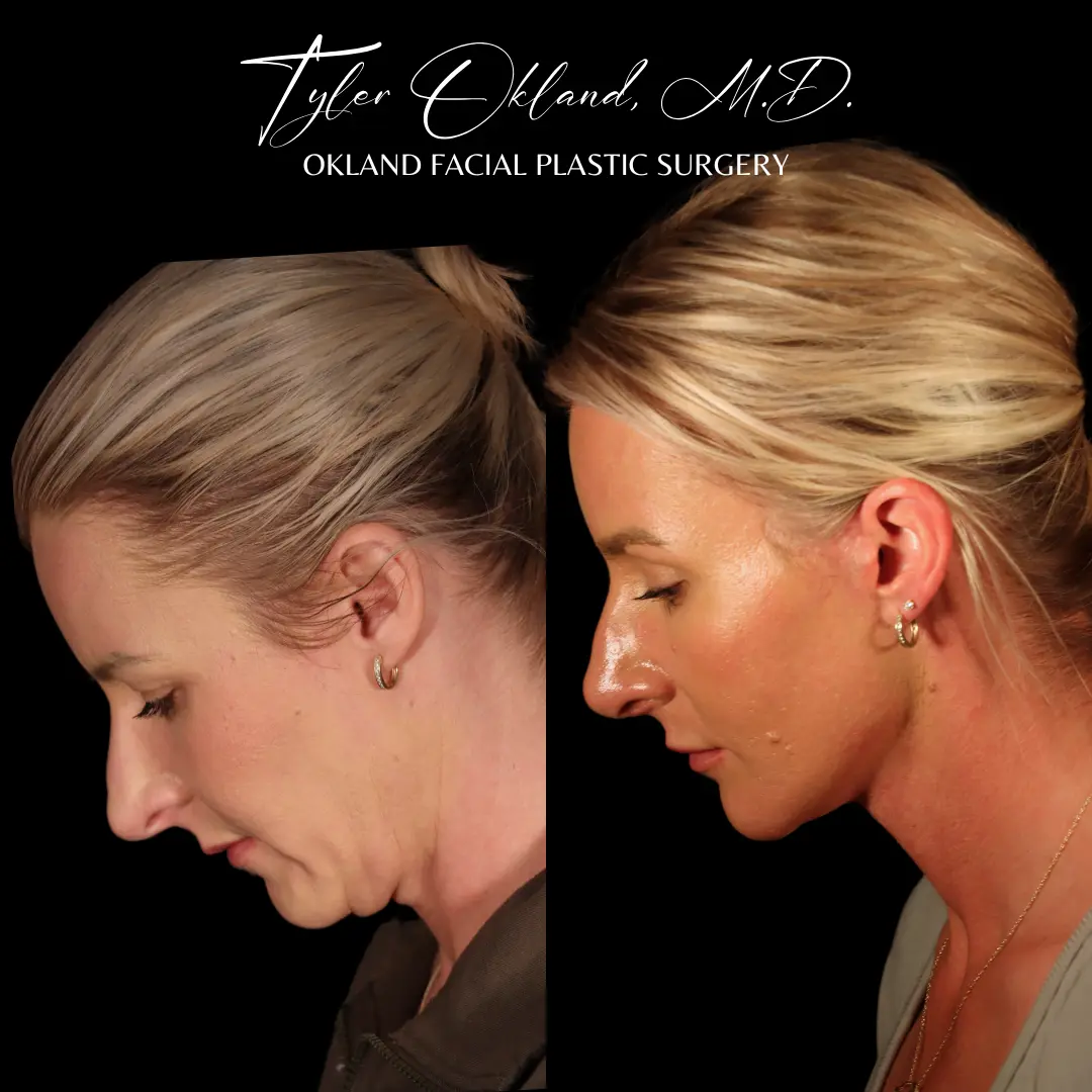 Before and after deep plane facelift and facial rejuvenation by Dr. Tyler Okland in Denver, case 03