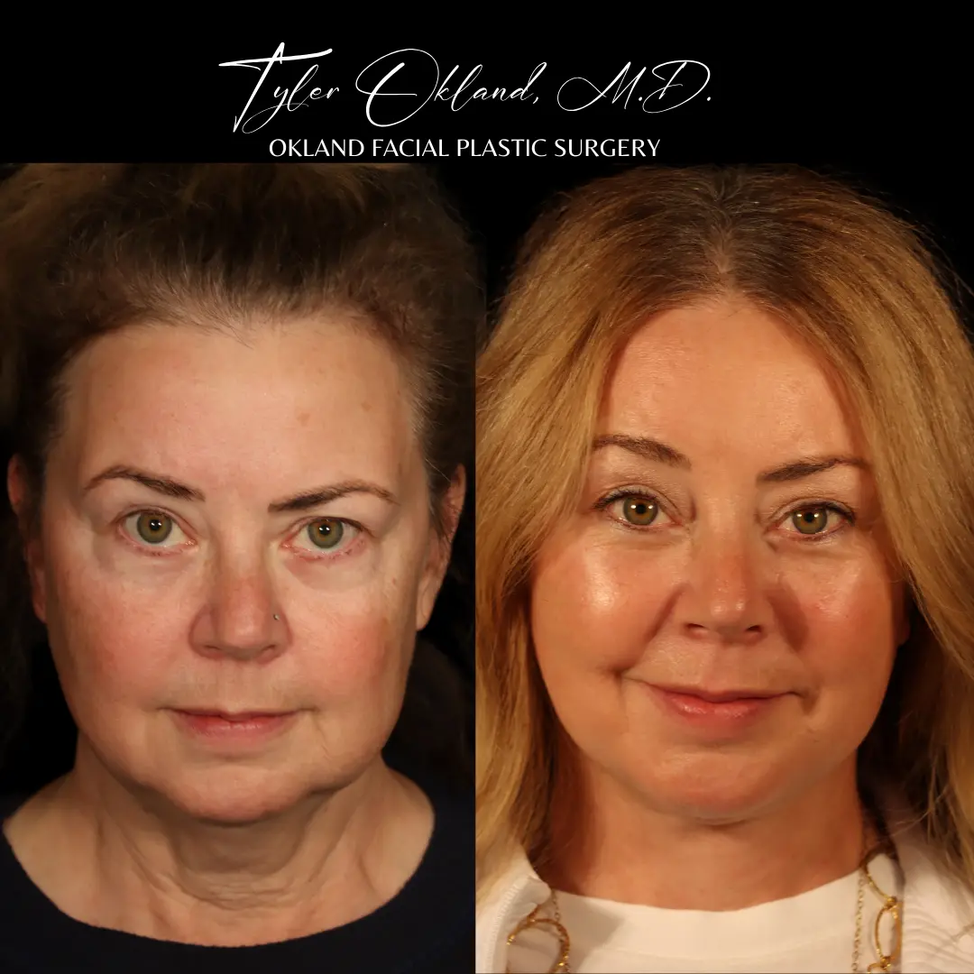 Before and after deep plane facelift and facial rejuvenation by Dr. Tyler Okland in Denver, case 05