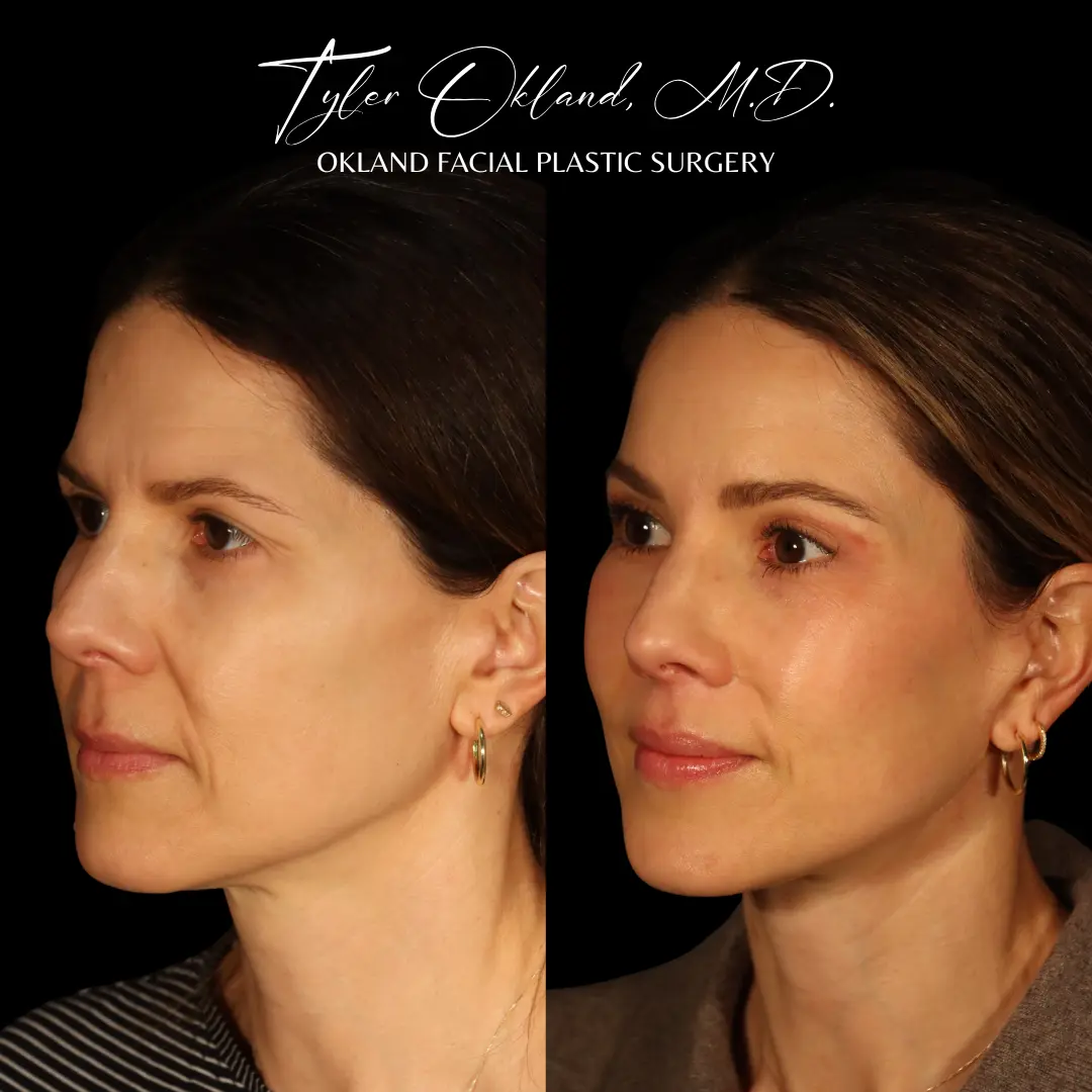 Before and after deep plane facelift and facial rejuvenation by Dr. Tyler Okland in Denver, case 06